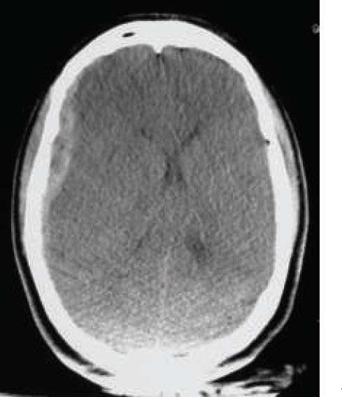 Subdural haematoma